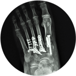 Результат остеосинтеза костей стопы Результат остеосинтеза костей стопы
