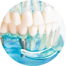 Классические коронки Классические коронки