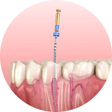 Лечение каналов зуба