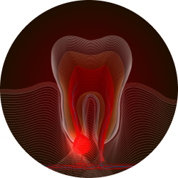 Корневая киста