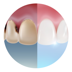 Лечение передних зубов