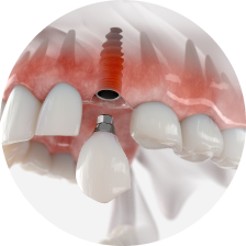 протез на вживленных имплантах