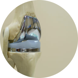 Реабилитация и восстановление после хондропластики коленного сустава