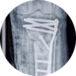 Восстановление и реабилитация после остеосинтеза надколенника Восстановление и реабилитация после остеосинтеза надколенника