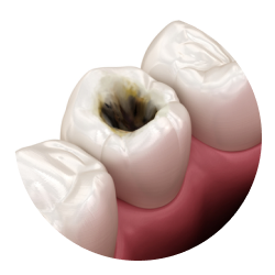 Глубокий кариес Глубокий кариес