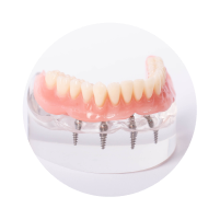 Мосты на имплантах