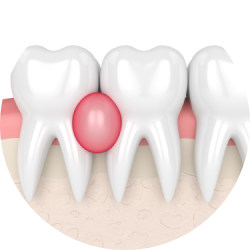 Резидуальная киста