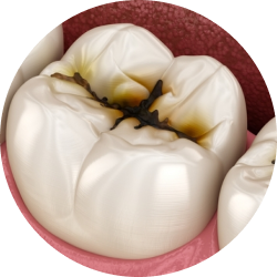 Лечение глубокого кариеса Лечение глубокого кариеса