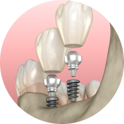 Мини импланты с отсроченной нагрузкой Мини импланты с отсроченной нагрузкой