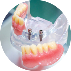 Мини импланты с немедленной нагрузкой Мини импланты с немедленной нагрузкой