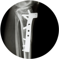 Результат операции остеосинтеза голени