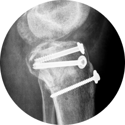 Результат остеосинтеза надколенника Результат остеосинтеза надколенника