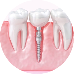 Мини импланты с формирователем десны Мини импланты с формирователем десны