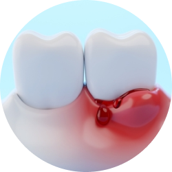 Острый периодонтит