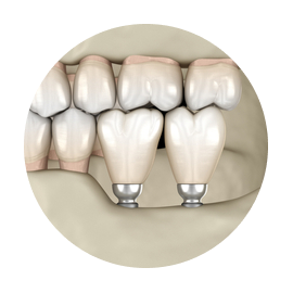 Мини импланты Мини импланты