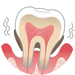 Хронический пародонтит
