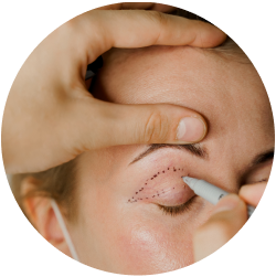 Восстановление после бесшовной блефаропластики