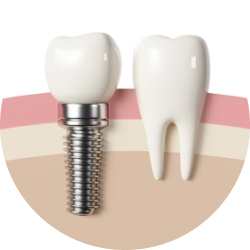 Импланты MIS UNO Импланты MIS UNO