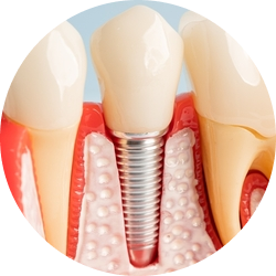 Одноэтапная имплантация Одноэтапная имплантация