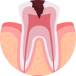 Лечение пульпита Лечение пульпита