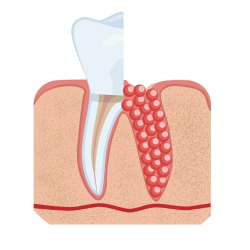 Гемисекция