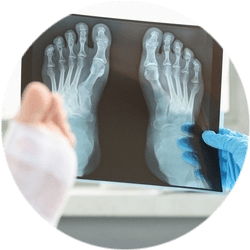 Результат операции Вейля Результат остеотомии Вейля