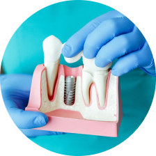 Временные коронки из циркония