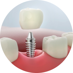 Импланты ET Импланты ET