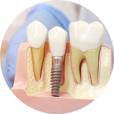Металлокерамические коронки Металлокерамические коронки