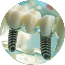 Одноэтапная имплантация Одноэтапная имплантация