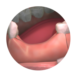 Костная пластика при имплантации зубов