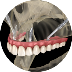Скуловая и базальная имплантация
