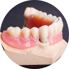 Керамические вкладки Керамические вкладки
