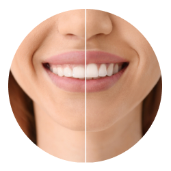 Гингивопластика