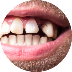 Цистэктомия