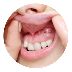 Удаление кисты зуба