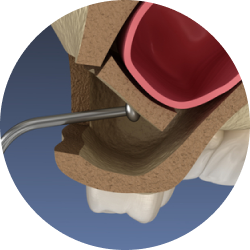 Синус-лифтинг