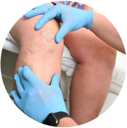 Результат операции Результат лазерной коагуляции сосудов