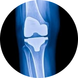 Результат редрессации суставов и возможные осложнения