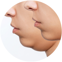 Результат липосакции подбородка