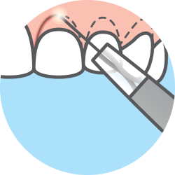 Щадящая (частичная)