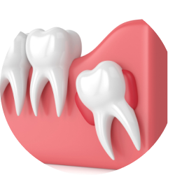 Прорезывания киста