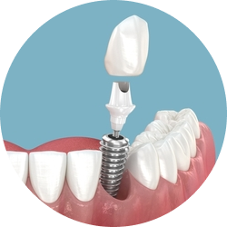 Импланты Tapered Effect Импланты Tapered Effect