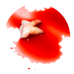 Сложное удаление зуба