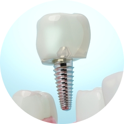 Импланты MIS M4 (BioCom) Импланты MIS M4 (BioCom)