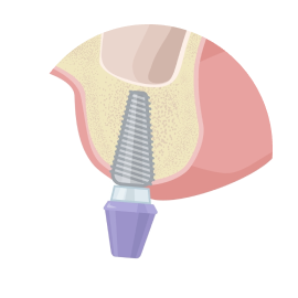 Открытый синус-лифтинг Открытый синус-лифтинг