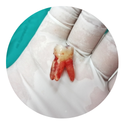 Удаление коренного зуба Удаление коренного зуба