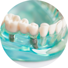 Металлокерамические мосты