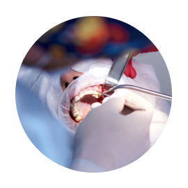 Синус-лифтинг Синус-лифтинг