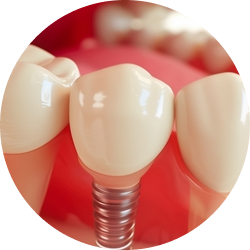 Импланты MIS Seven Импланты MIS Seven